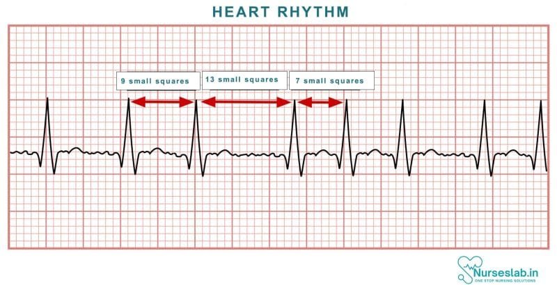 Reading ECG: Made Simple for Nurses - Nurseslab