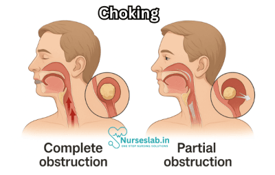 The Chocking Process Understanding the Choking Condition - Nurseslab