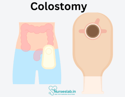 Colostomy Procedure: Changing & Emptying Ostomy Pouches - Nurseslab
