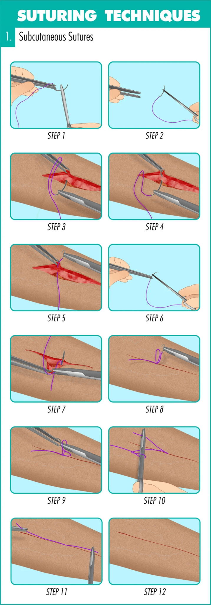 How to do Suturing: Explained - Nurseslab