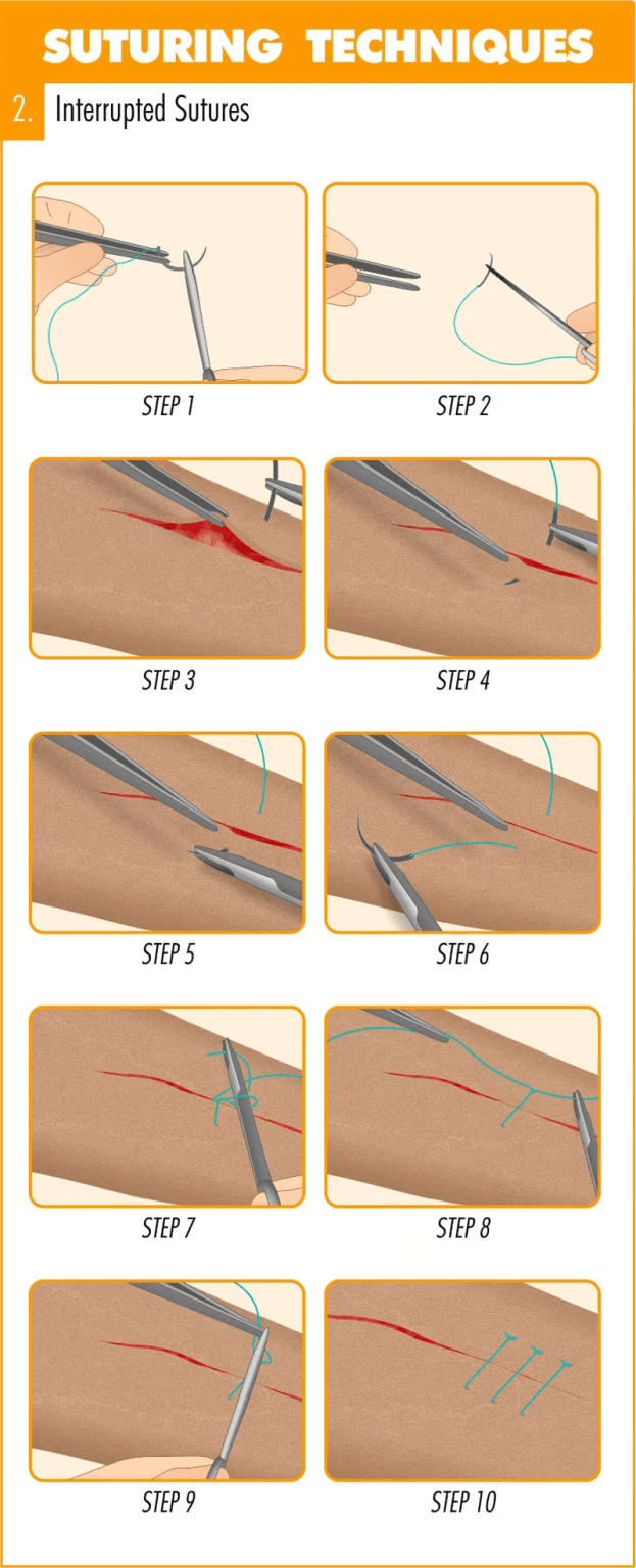 How To String Suture How to do Suturing: Explained - Nurseslab