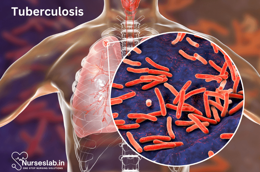 Tuberculosis and its Management