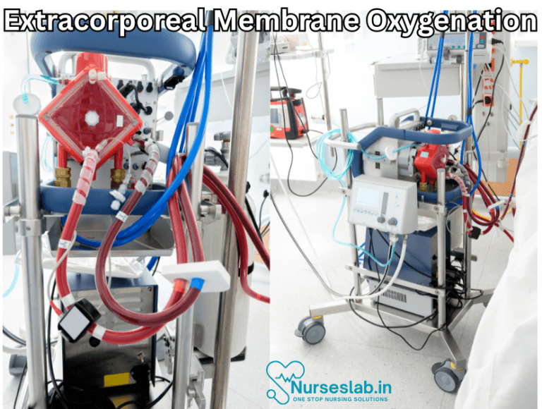Ecmo Ramp Basics of Extracorporeal Membrane Oxygenation (ECMO) - Nurseslab