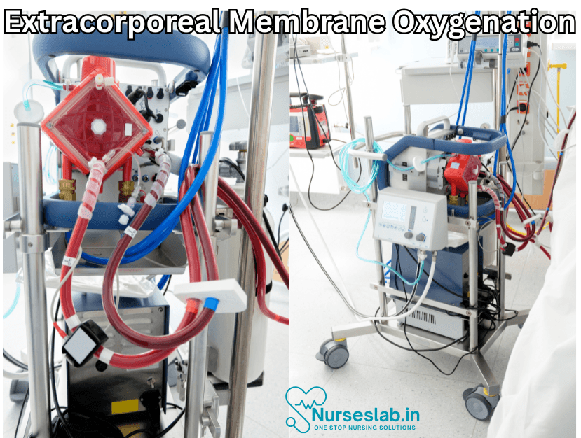 Extracorporeal Membrane Oxygenation 