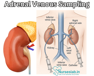 Adrenal Venous Sampling (AVS) Procedure - Nurseslab