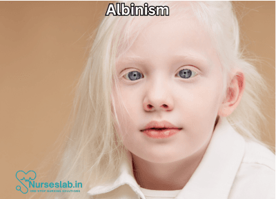 Albinism: A rare-genetic condition - Nurseslab