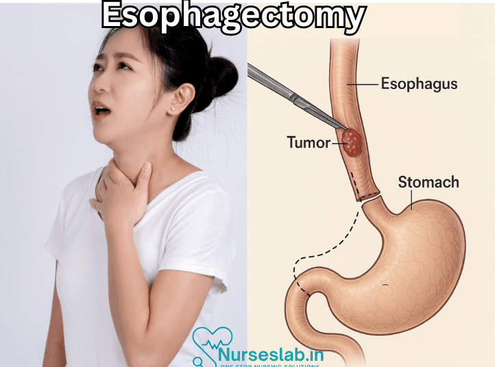 Esophagectomy Surgery