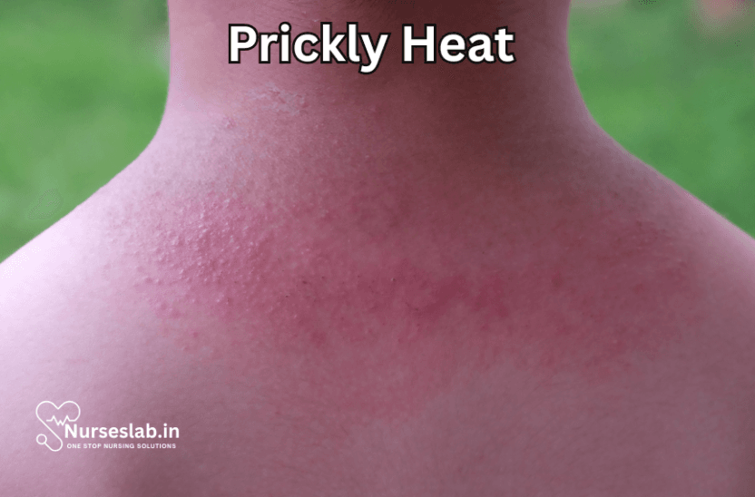 First Aid for Heat Rash - Nurseslab