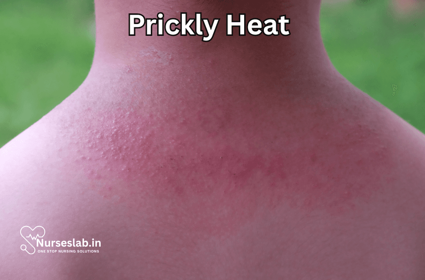 First Aid for Heat Rash