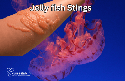 First Aid For Jellyfish Stings Nurseslab first-aid-for-jellyfish-stings-nurseslab