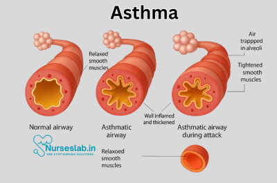 First Aid for Asthma Without an Inhaler - Nurseslab