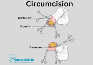Circumcision - Nurseslab
