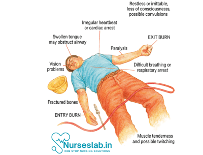 First Aid for Electrical Injuries - Nurseslab