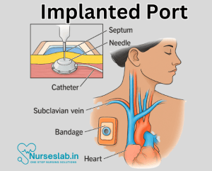Implanted Port: Overview of its Use and Benefits - Nurseslab