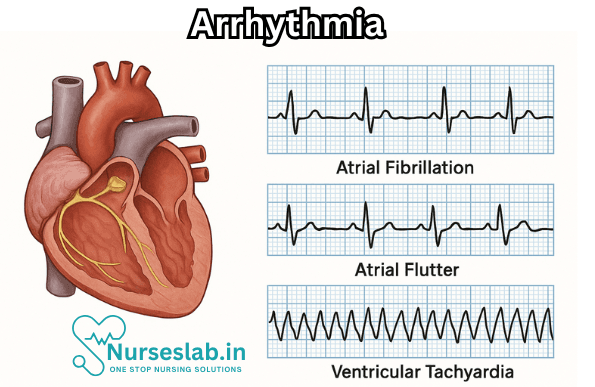 Arrhythmia