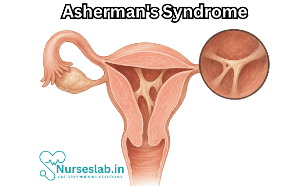 Asherman's Syndrome