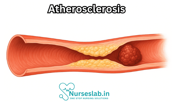Atherosclerosis