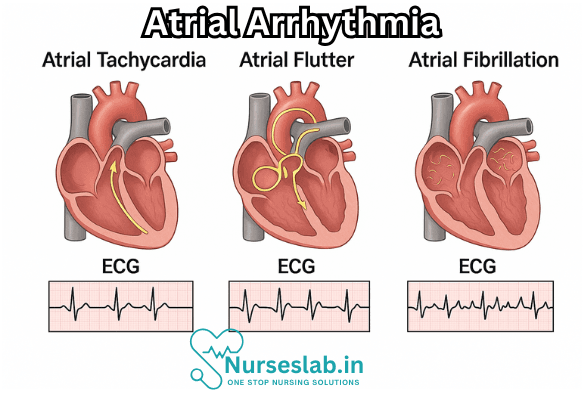 Atrial Arrhythmias 2 Atrial Arrhythmia