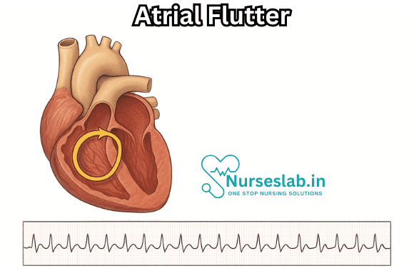 Atrial Flutter