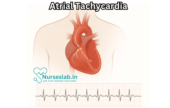 Atrial Tachycardia