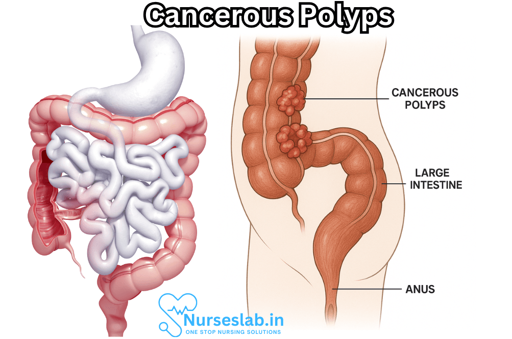Cancerous Polyps