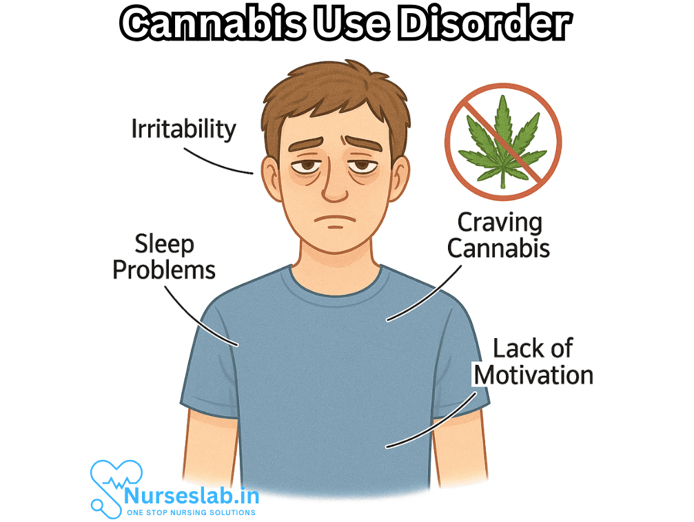 Cannabis Use Disorder