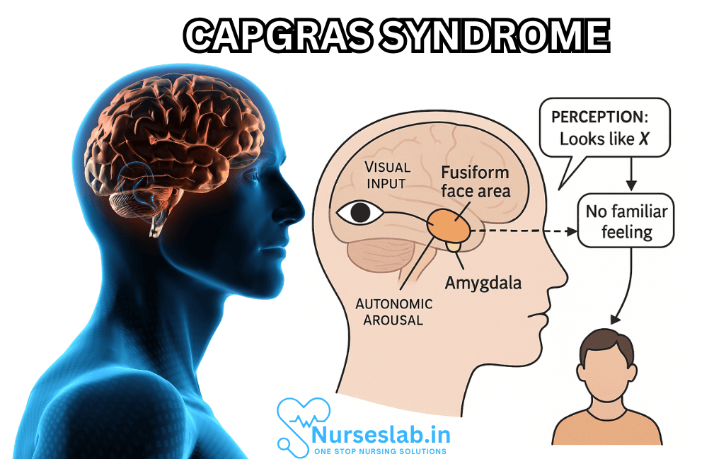Capgras Syndrome