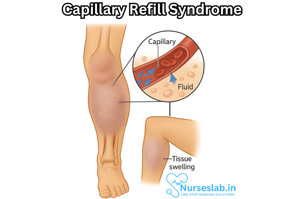 Capillary Leak Syndrome