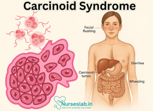 Carcinoid Syndrome - Nurseslab