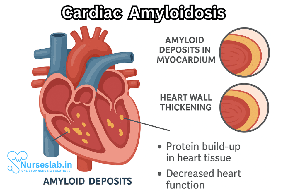 Cardiac Amyloidosis