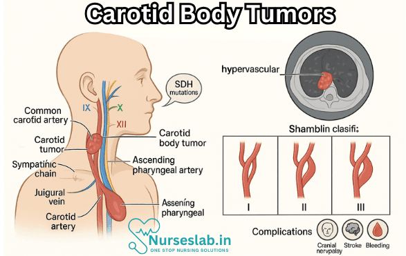 Carotid Body Tumors