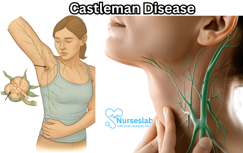 Castleman Disease - Nurseslab