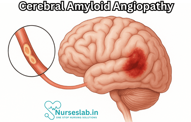 Cerebral Amyloid Angiopathy
