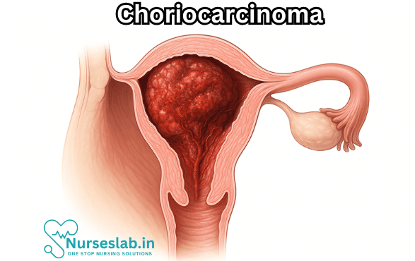 Choriocarcinoma: A Comprehensive Overview 2 Choriocarcinoma