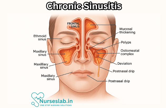 Chronic Sinusitis