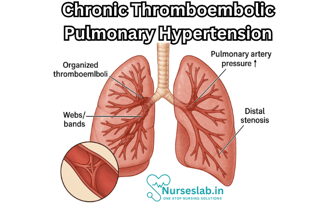 Chronic Thromboembolic Pulmonary Hypertension