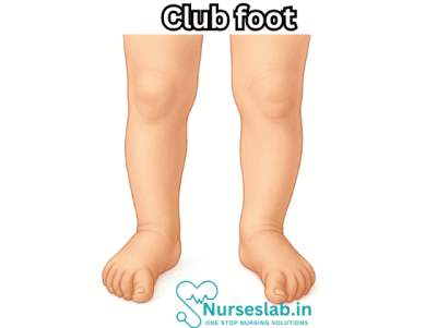 Club Foot: A Detailed Explanation - Nurseslab