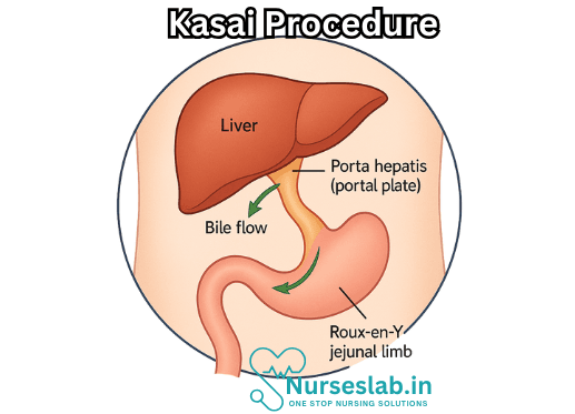 Kasai Procedure: A Lifeline for Infants with Biliary Atresia 2 Kasai Procedure