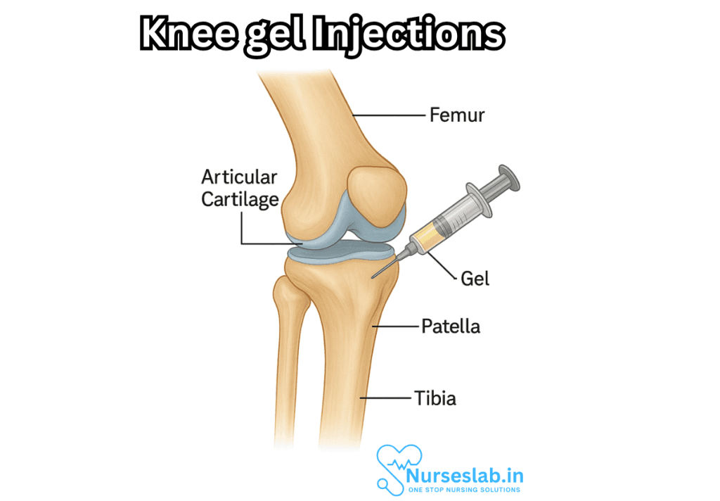 Knee Gel Injections 