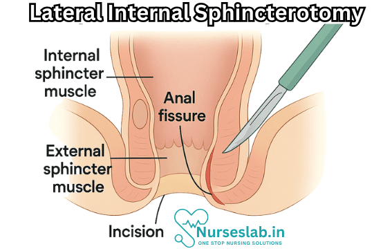 Lateral Internal Sphincterotomy
