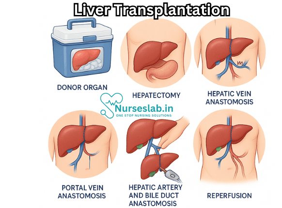 Liver transplantation