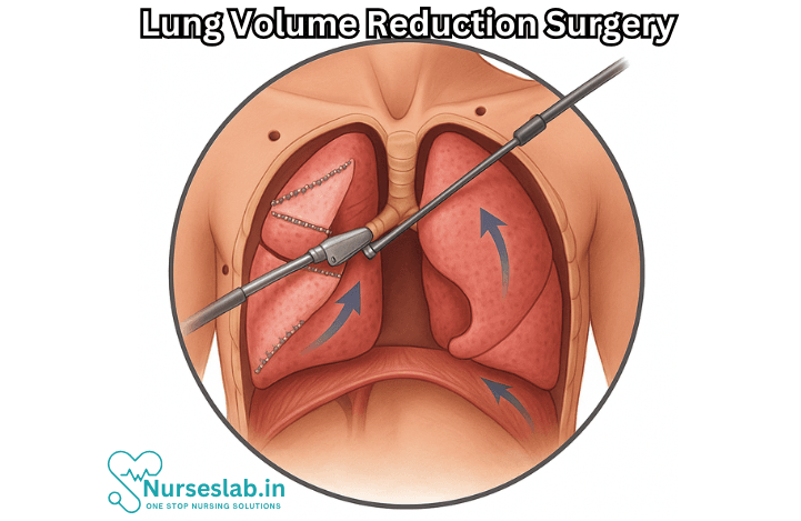 Lung Volume Reduction Surgery
LVRS 