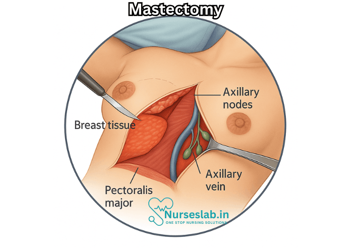 Mastectomy