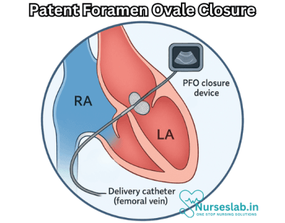 PFO Closure - Nurseslab