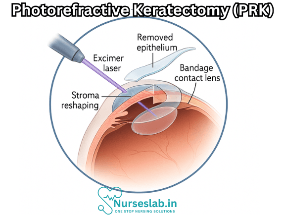 Photorefractive Keratectomy (PRK) 2 Photorefractive Keratectomy