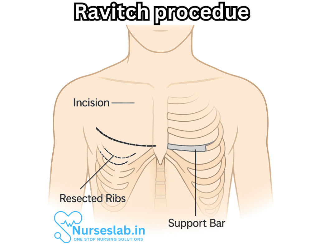 Ravitch Procedure