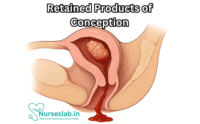 Retained Products of Conception