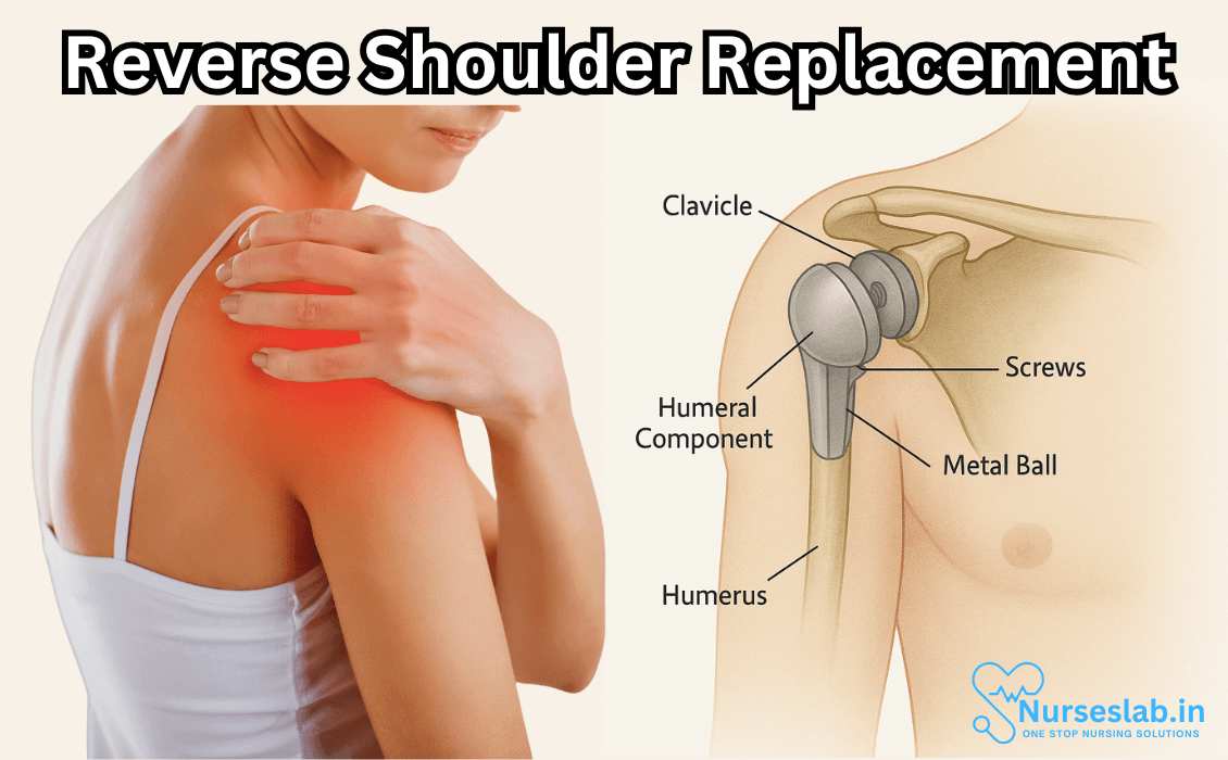 Reverse Shoulder Replacement - Nurseslab