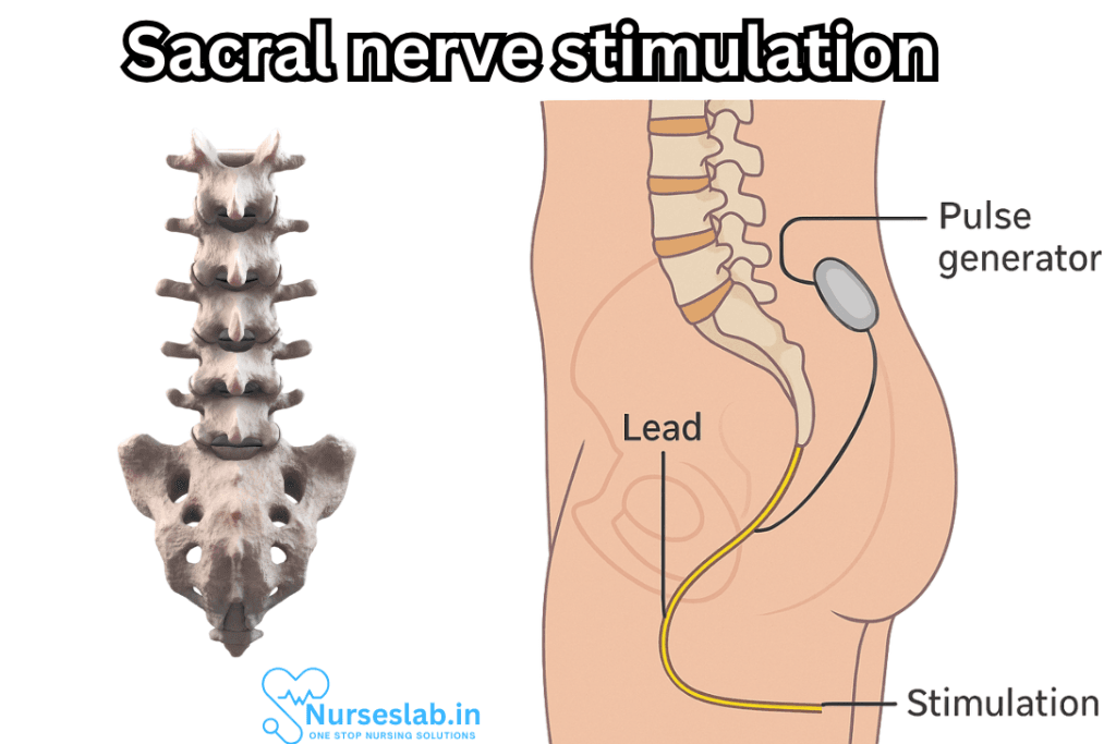 Sacral Nerve Stimulation