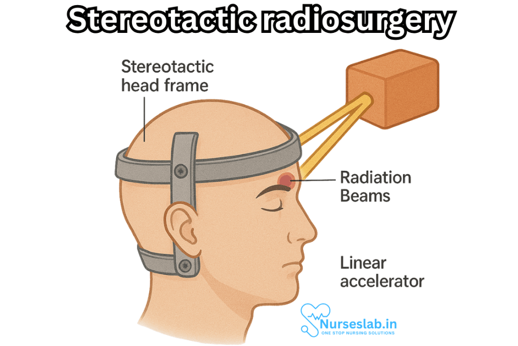 Stereotactic radiosurgery
